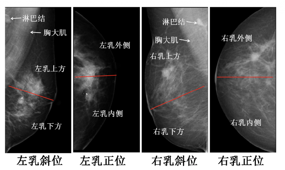 乳腺鉬靶報(bào)告看不懂？七喜醫(yī)療三分鐘教會(huì)你