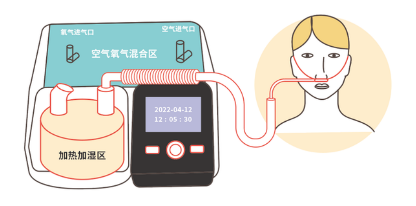 高流量氧療有哪些特點(diǎn)?